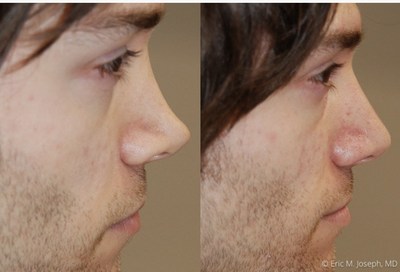 Permanent non-surgical nose job with microdroplet Silikon-1000 for repair of a low nasal bridge after previous rhinoplasty surgery performed elsewhere.