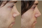 How To Know If A Permanent Non-Surgical Nose Job Is Too Good To Be True by Eric M. Joseph, M.D.