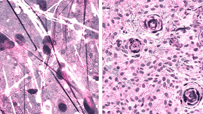 Stimulated Raman histologic images of diffuse astrocytoma (left) and meningioma (right).