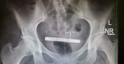 X-Ray of the Pelvis Shows an Extremely Narrow Vibrator Lodged in the Bladder, Prior to Surgical Removal by the Marchand Institute