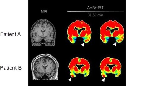 PET scans of two patients with mesial temporal lobe epilepsy showing elevated accumulation of AMPA receptors at the white arrows (PRNewsfoto/Yokohama City University)