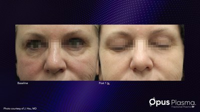 Before and after one treatment with Alma's new Opus Plasma.