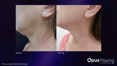Visible results after one treatment with Alma's new Opus Plasma.