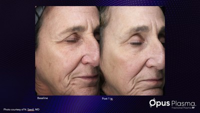 Results with just one treatment of Alma’s new Opus Plasma.