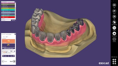 The improved thimble crown workflow for virtual gingiva-supported frameworks significantly reduces design time while increasing overall quality and consistency.