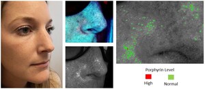 Introducing ARMADA™ UV - Smartphone-based skin follicular oil / sebum image detection technology developed by Galileo Group, Inc.