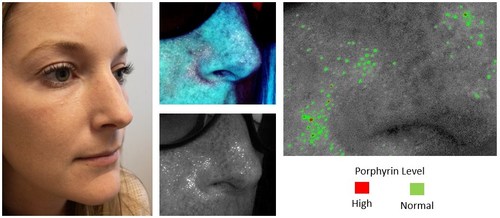 Left - Galileo Group subject model in natural image. Center and Right - Sectional view insert showing Sebum spots fluorescing and highlighting through use of ARMADA™ smartphone spectral imagery and automated processing algorithms. Clear, distinctive signals which amongst other output, can be quantified into different Porphyrin levels.