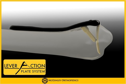 Lever Action Plate System™ by McGinley Orthopedics: 
The Lever Action Plate System™ is a dynamic, fragment reduction technology that assists surgeons in restoring volar tilt and articular congruity.
