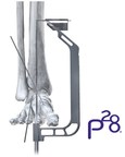 Paragon 28® Phantom® ActivCore Nail System Receives 510(k) Clearance - Continuous Compression Hindfoot Nail System