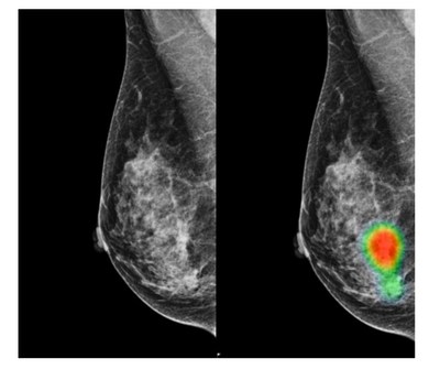 Mammograms of a 49-year-old woman with invasive lobular carcinoma on the right-side breast. A small mass with micro-calcifications on the right-side breast was detected correctly by AI with an abnormality score of 96%. This case was recalled by 7 out of 14 radiologists (4 breast radiologists and 3 general radiologists) initially (without AI) and all 14 radiologists recalled this case correctly with the assistance of AI. 