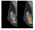 AI-assisted Radiologists Can Detect More Breast Cancer with Reduced False-positive Recall