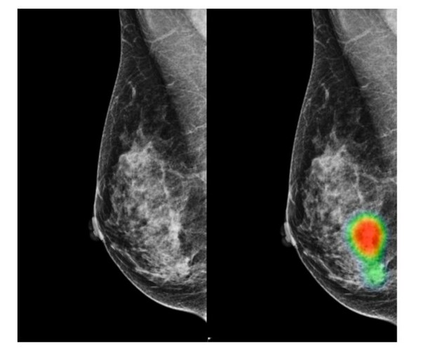 Mammograms of a 49-year-old woman with invasive lobular carcinoma on the right-side breast. A small mass with micro-calcifications on the right-side breast was detected correctly by AI with an abnormality score of 96%. This case was recalled by 7 out of 14 radiologists (4 breast radiologists and 3 general radiologists) initially (without AI) and all 14 radiologists recalled this case correctly with the assistance of AI.