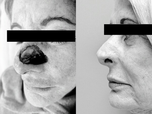 60 year old female pre and post skin flap to repair nose after Mohs chemosurgery to remove basal cell carcinoma.