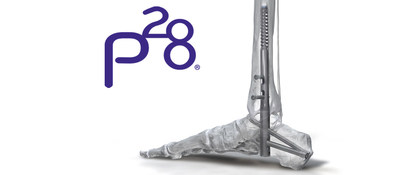 Phantom&reg; Hindfoot TTC Nail