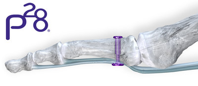 TenoTac&trade; Soft Tissue Fixation System