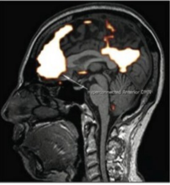 A picture from the fMRI study, Ms. Barris's brain on left shows typical reaction of people complaining of headaches when exposed to electromagnetic radiation compared with the control on right showing no reaction. Bright area shows hyper connectivity in the frontal lobe of the brain when exposed to electromagnetic radiation.