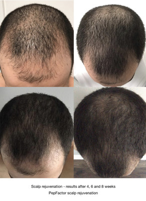 Scalp Rejuvenation After 4 Treatments with PepFactor Scalp