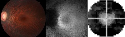 The retinal pigment degenerates in XLRP-RPGR, which changes its appearance on exam (left panel) and on specialized photography (center). This leads to tunnel vision (right).