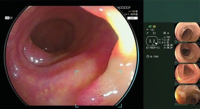Fujifilm acquires CE mark and launches CAD EYE, AI function for colonic polyp detection