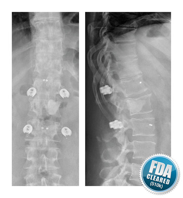 Treatment of a Plasmocytoma in L2 with BlackArmor&reg; Carbon/PEEK screws (PRNewsfoto/AO Foundation)