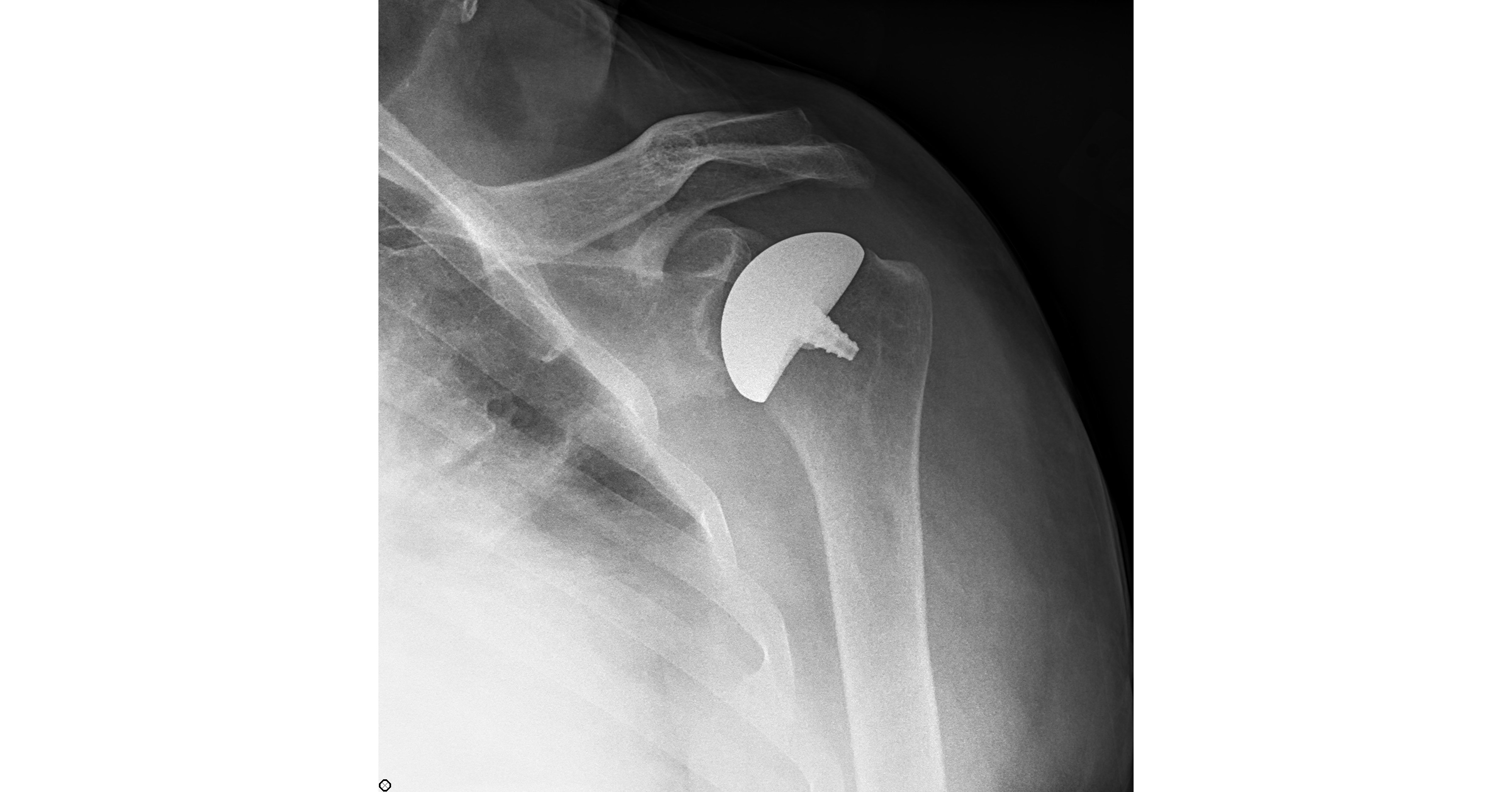 Clinical Study Shows Improved Clinical High Rate of Return to