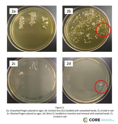 Eye-popping photos from the Centre for Ocular Research & Education (CORE) illustrate the difference between handling contact lenses with clean and unwashed hands. Taking care of contact lenses with clean, dry hands is essential, say eye health experts.