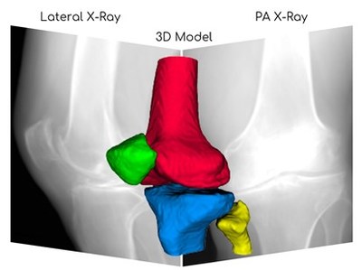 3D Reconstruction of Knee from X-ray Images