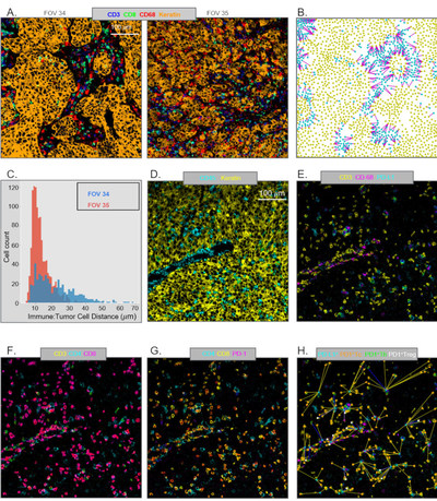 Figure 2. Différences dans l’architecture des microenvironnements tumoraux : la distribution spatiale des cellules immunitaires et des cellules tumorales. (PRNewsfoto/IONpath, Inc.)