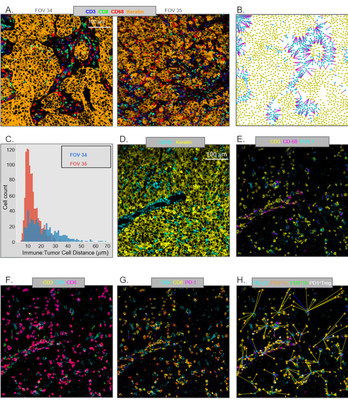 Fig. 2. Diferencias en la arquitectura TME: distribución espacial de células inmunes y células tumorales. (PRNewsfoto/IONpath, Inc.)