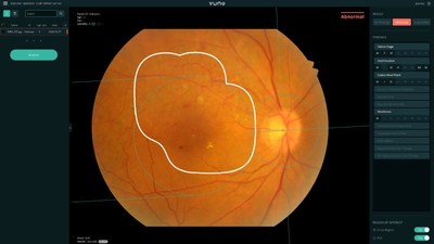 VUNO Med(R)-Fundus AI(TM) receives MFDS Regulatory Approval as Class III Medical Device