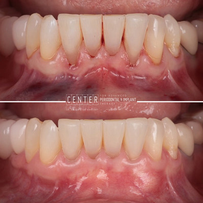 Before and After of the Rejuvagum Lift treatment for gum recession.