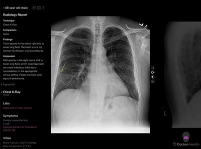 Braid Visual Radiology Report for a patient who later tested positive for Covid-19