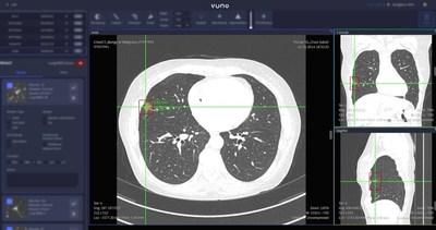 Product screenshot of VUNO Med®-LungCT AI™