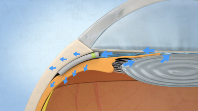 First truly biocompatible MIGS implant from iSTAR Medical shows consistently outstanding efficacy in patients with glaucoma