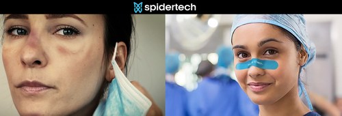 SpiderTech face protection strips help our front line hero’s from mask burn. (CNW Group/SpiderTech)
