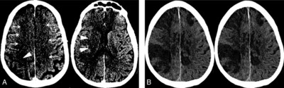 A, NCCT on the day of admission demonstrates subtle findings of acute ischemia in the right MCA (arrowheads) and bilateral ACA (arrows) territories, including hypoattenuation and loss of gray-white differentiation. B, Repeat NCCT on hospital day 2 demonstrates progression of acute infarcts in the right MCA and bilateral ACA territories, including worsening edema and mass effect.