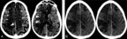 Case Study Documents Link between Acute Ischemic Strokes and COVID-19