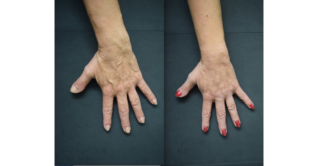 Bulging Hand Veins Permanently Removed With 'Rejuvahands™' Procedure