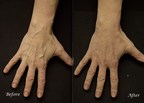 Bulging Hand Veins Permanently Removed With 'Rejuvahands™' Procedure