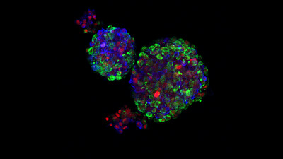 Human breast organoids. The organoids were grown in 3D matrix (matrigel) and treated with DOX to induce cMYC expression (red). The cultures were fixed and then stained with antibodies that recognized each of these proteins: Green = cytokeratin 5 = basal breast cells; Blue = cytokeratin 8 = luminal breast cells (the ones that produce milk); Red = cMYC (the oncogene described in this study). Photo credit: Chen Chen.