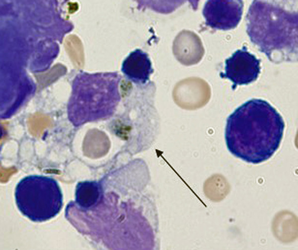 This is a microscopic photo of a blood smear from a transgenic mouse that mimics the human immune disorder, secondary HLH (hemophagocytic lymphohistiocytosis). The image shows macrophage immune cells (indicated by arrow) flooding healthy tissue cells during a cytokine storm caused by HLH in a very similar fashion to what occurs in patients with severe COVID-19 disease. Researchers report data in the Journal of Allergy and Clinical Immunology.