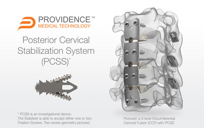 PCSS is a unique surgical implant system composed of non-segmental instrumentation with integrated screw fixation intended to provide immobilization and stabilization of spinal segments. PCSS achieves bilateral facet fixation at each level by spanning the interspace with points of fixation at each end of the construct.