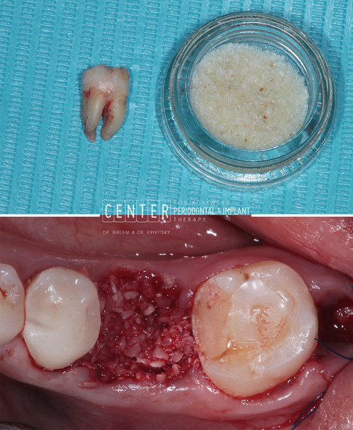 The top image shows a tooth that was extracted, cleaned, and prepared into a holistic bone graft alternative. The bottom image demonstrates the material once grafted into mouth.