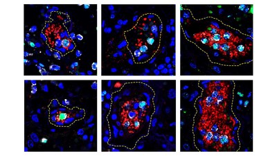 Photomicrographs of human lung tissue taken from a patient who died of COVID-19. These are examples of the Neutrophil Extracellular Trap (NET) structures associated with small blood clots. Small blood vessels are outlined with yellow dashed lines, NETs are identified by the presence of neutrophils (in gray) and altered DNA-associated proteins (green). Platelets in the blood clots are in red. Blue color stains DNA in all cells. Credit: Xue-Yan He and David Ng, Egeblad lab/CSHL, 2020.