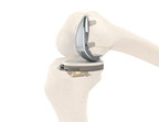 Engage Surgical Announces FDA 510(k) Clearance And Limited Market Release Of The Cementless Engage™ Partial Knee System
