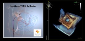 NuVera Announces Successful First-in-Human Use of NuVision™ ICE Catheter