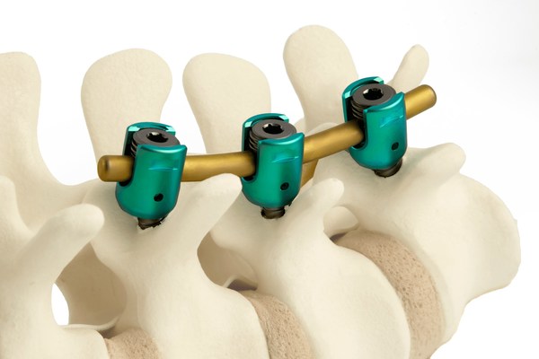 ulrich medical USA® Inc. Momentum Posterior Spinal Fixation System