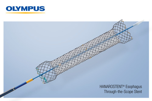 HANAROSTENT® Esophagus Through the Scope stents are 510(k) cleared devices made by M.I. Tech and now distributed exclusively through Olympus in the U.S for use in palliative treatment of esophageal stricture and/or trachea-esophageal fistula caused by malignant tumors.