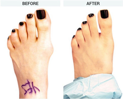 Bunion Surgery Before and After Photos