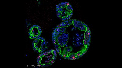 Researchers discovered that pancreas cancer subtypes can switch between a slow-growing type and another more invasive and deadly form. This image shows human pancreas tumor “organoids”. The organoids contain many cells that overexpress K-Ras (in red), a notorious driver of many cancers. Cells that express more K-ras behave more dangerously, dividing more frequently and invading surrounding tissues. Credit: Miyabayashi/Tuveson lab.